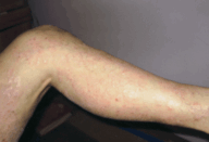 Mike Trouern-Trend 2 Mike Suffered from Psoriasis Sufferer for 29 Years; Finally Finds Relief